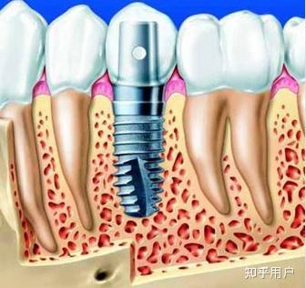 它包括下部的支持种植体和上部的牙修复体两部分-第1张图片-深圳市凯迪瑞门窗科技有限公司